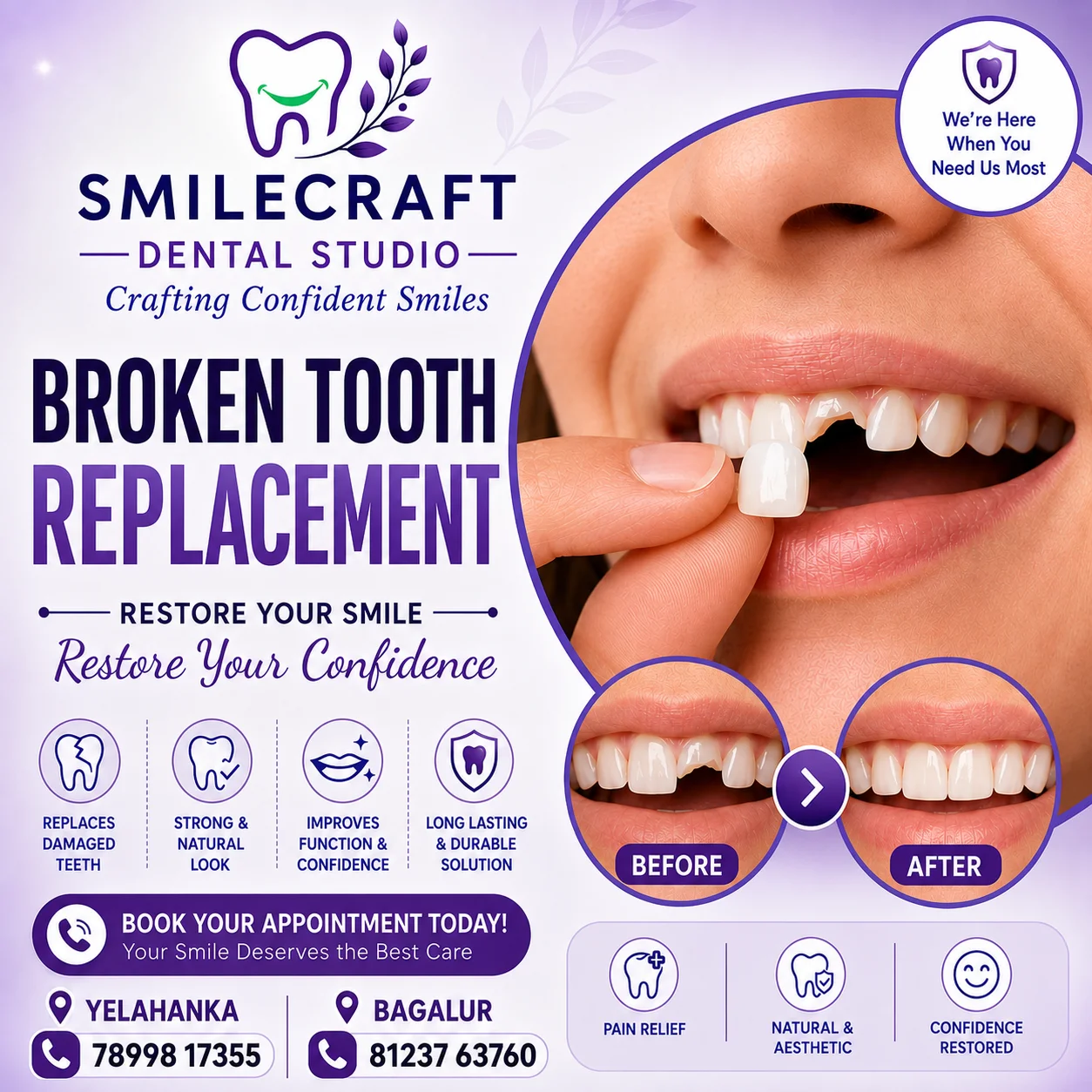 Broken Tooth Replacement in Yelahanka & Bagalur | SmileCraft Dental Studio